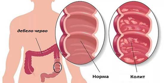 Как се излекувах от колит: разказ за нещата, които облекчават - Демир Бозан